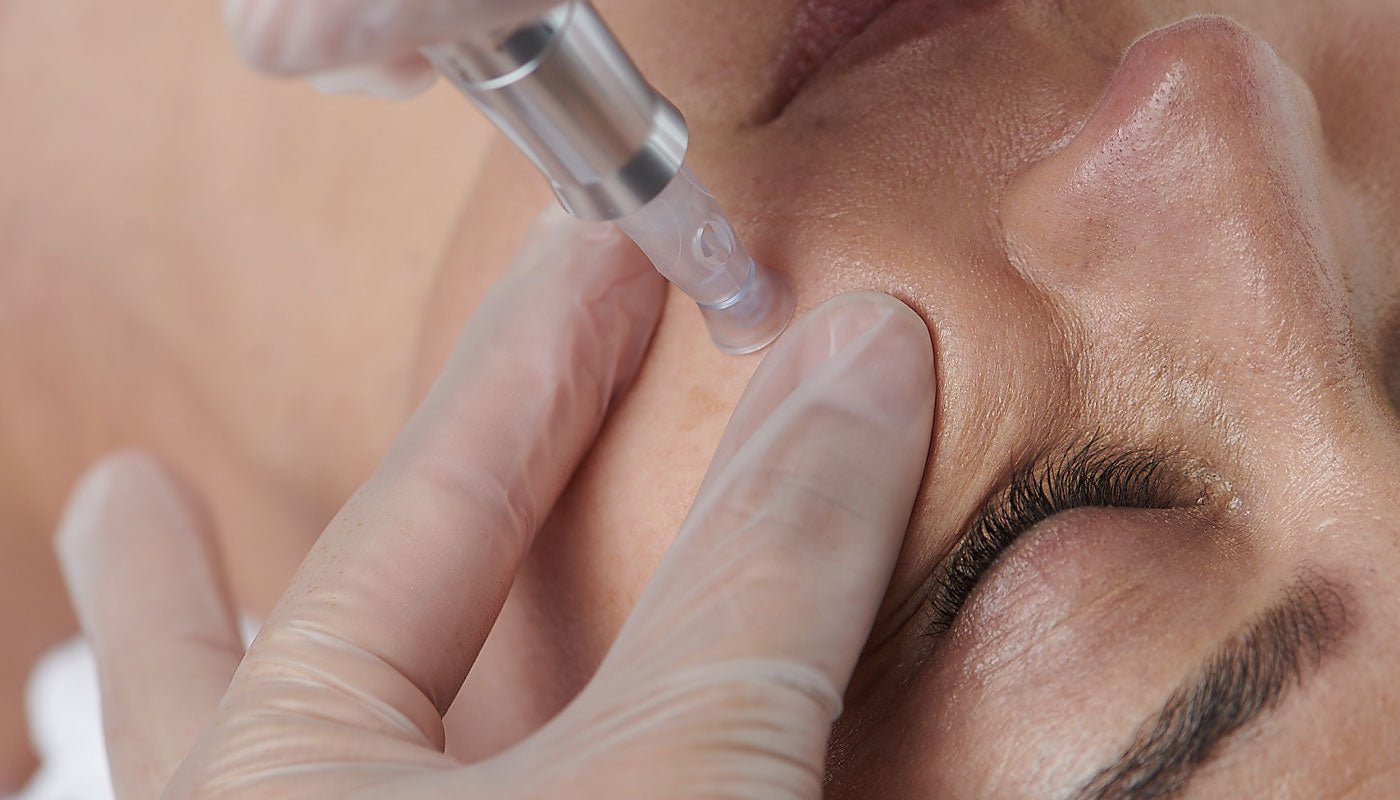 Micro needling treatment